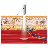laser probe 2